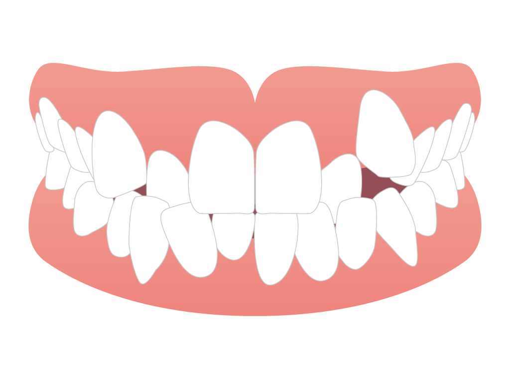 インビザラインGOの症例はどんなものがある？矯正できる歯並び例を紹介