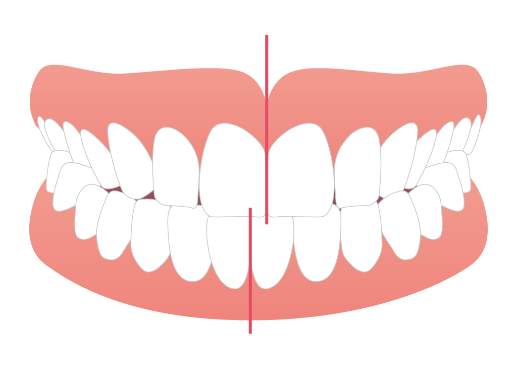 歯列矯正で顔は変わる！出っ歯や受け口（しゃくれ）の影響と変化パターンを紹介