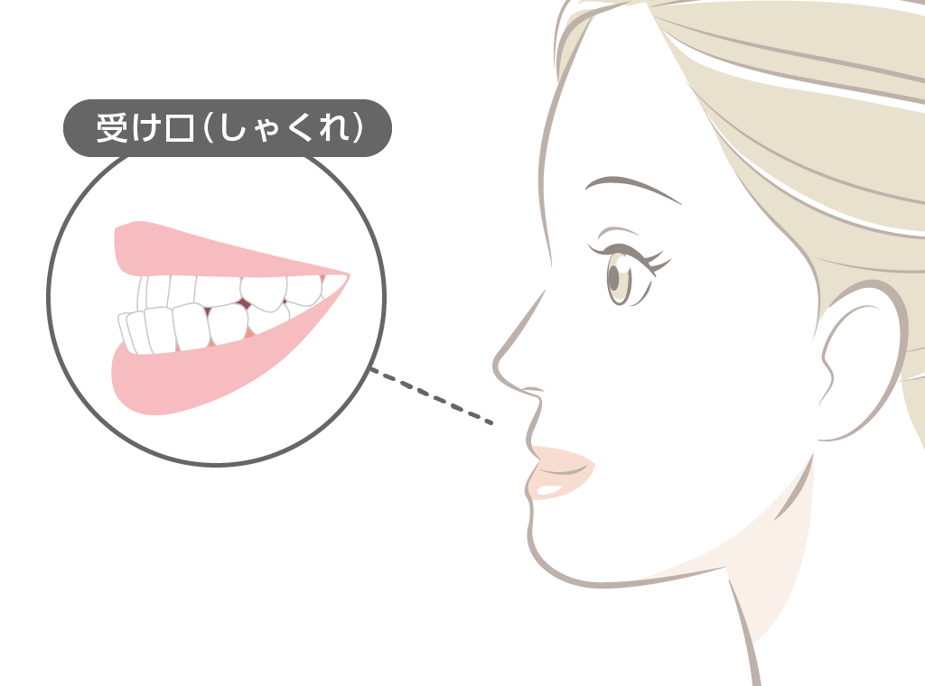 歯列矯正で顔は変わる！出っ歯や受け口（しゃくれ）の影響と変化パターンを紹介