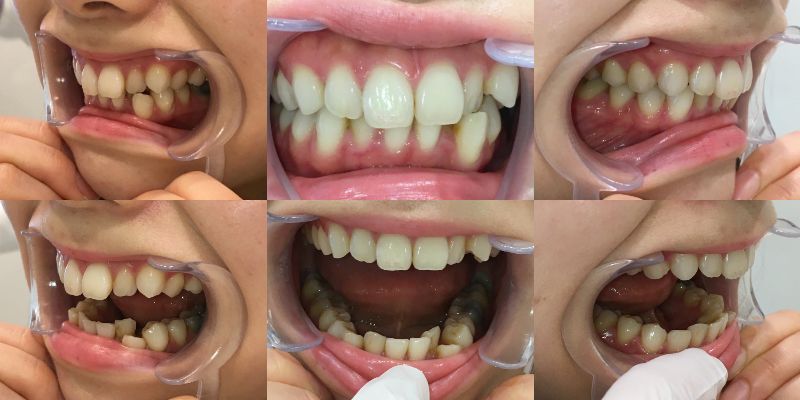 インビザラインで八重歯を矯正する方法と効果を詳しく解説